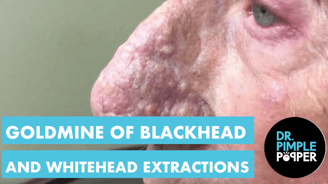 A Goldmine of Blackheads & Whiteheads