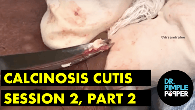 Calcinosis Cutis, Session Two, Part Two