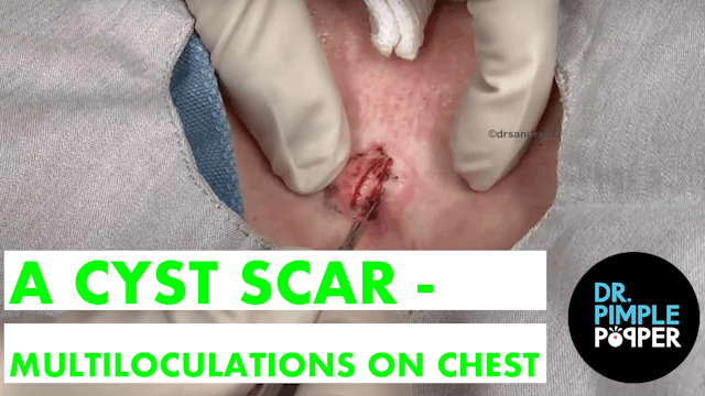 A Cyst Scar - Multiloculations on Mid...