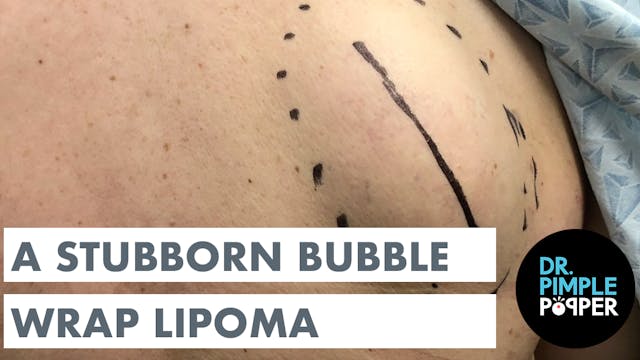 A Stubborn Bubble Wrap Lipoma