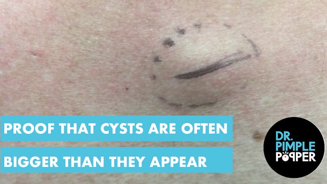 Proof Cysts are often Bigger than they Appear!