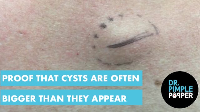 Proof Cysts are often Bigger than the...