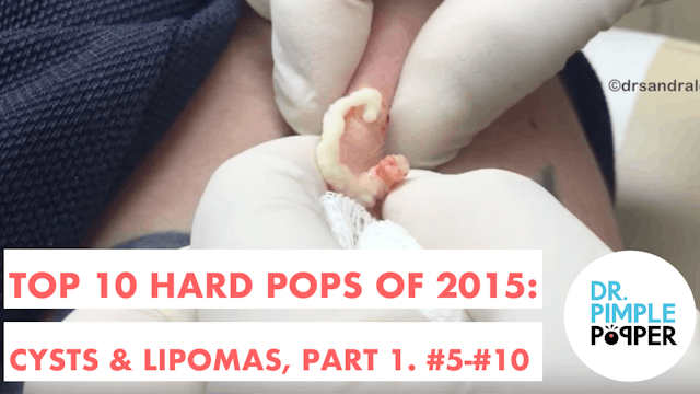 My Top 10 Hard Pops of 2015: Cysts & ...