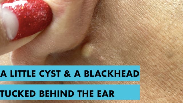 A Little Cyst & A Blackhead Tucked Be...