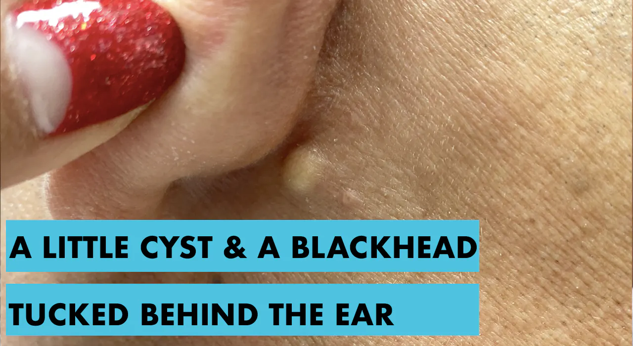 Dr Pimple Popper Blackheads In Ears