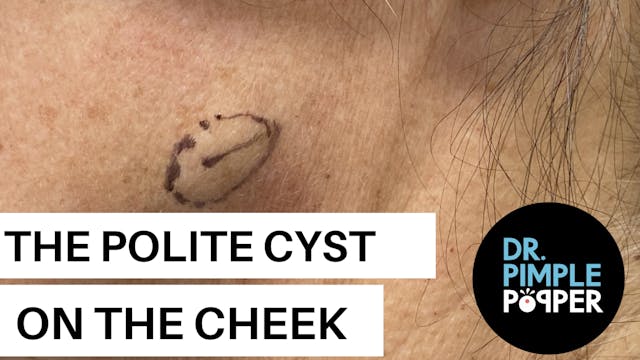 A Polite Cyst on the Cheek