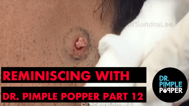 Reminiscing with Dr Pimple Popper TBT...