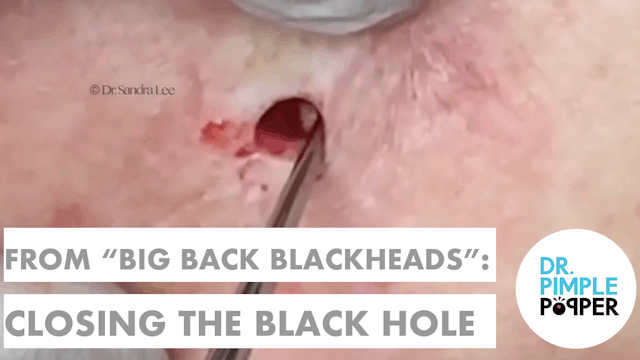 From "Big Back Blackheads": Closing t...
