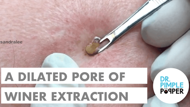 FINALLY, a Dilated Pore of Winer!