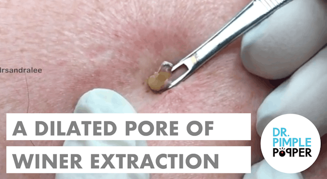FINALLY, a Dilated Pore of Winer!