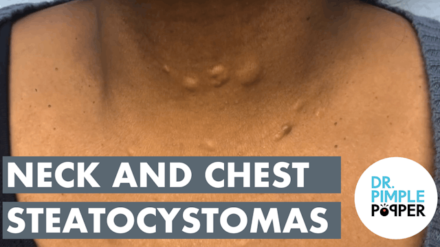 Neck and Chest Steatocystoma