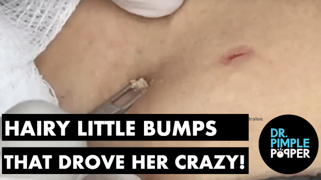 Hairy Little Bumps that Drove her Crazy!