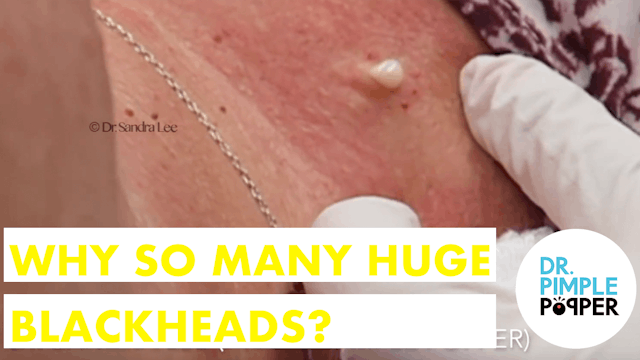 Why So Many HUGE Blackheads? (Momma Squishy Part 1)