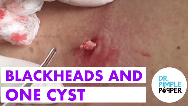 Blackheads and One Cyst