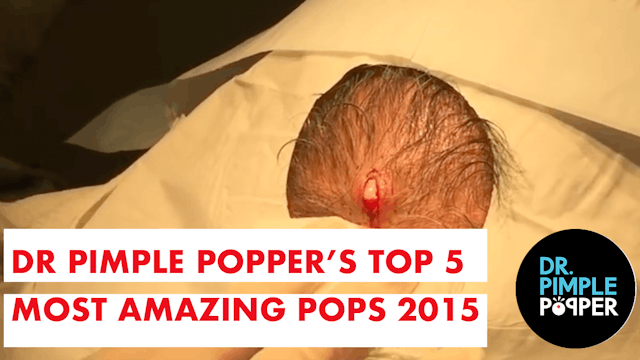 A Dr Pimple Popper's Top 5 Most Amazing "Pops" of 2015
