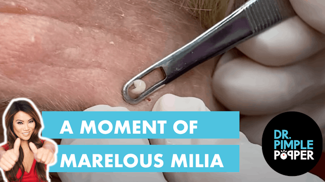 A Moment of Marvelous Milia