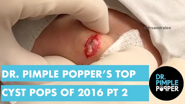 Dr Pimple Popper's Top 10 Cyst POPS of 2017, Part 2!