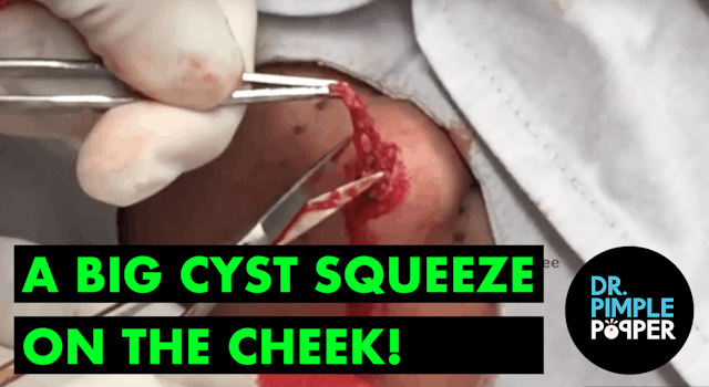 A Big Cyst SQUEEZE on the cheek: From...
