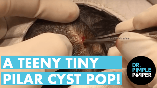 Teeny Tiny Pilar Cyst Pop