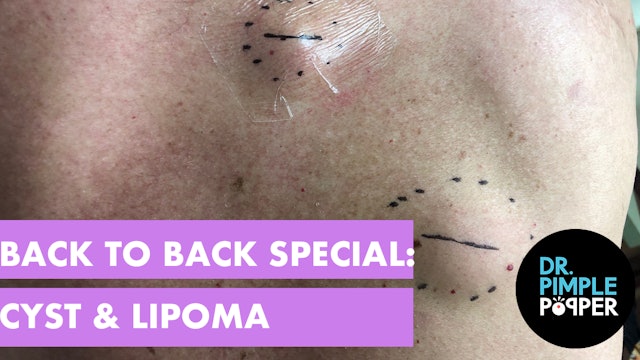 Back to Back Special- Lipoma and Cyst