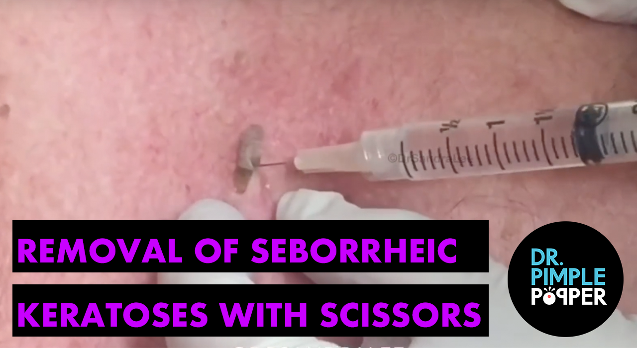 armpit cyst removal at home