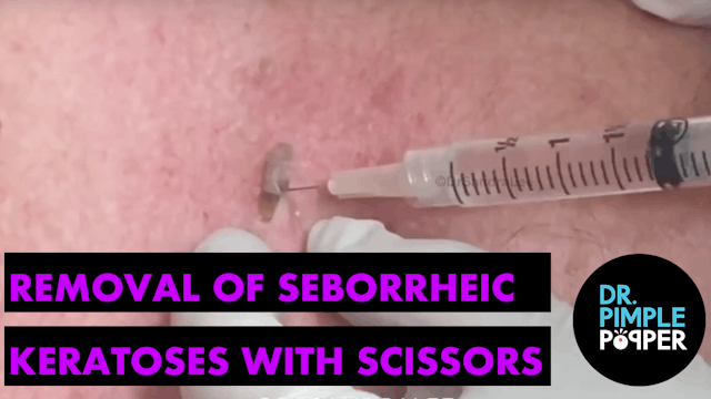 Removal of a Seborrheic Keratoses with Scissors