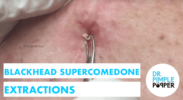 Blackhead Supercomedone Extractions: ...