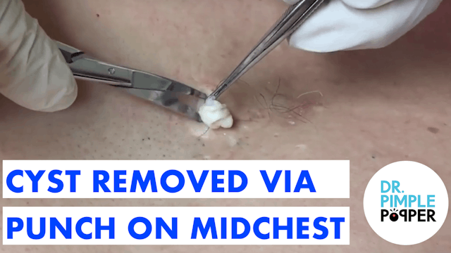 Cyst Removed via Punch on Midchest, & Blackheads Extracted