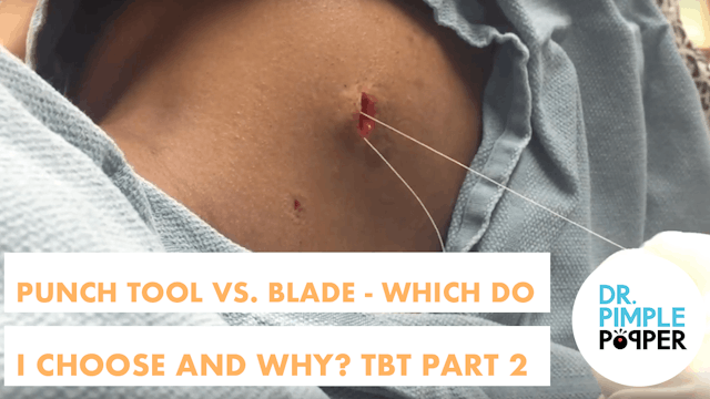 Punch Biopsy tool vs Surgical Blade: Which one? - TBT Part 2