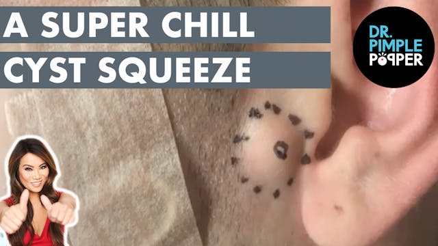 A Super Chill Cyst Squeeze