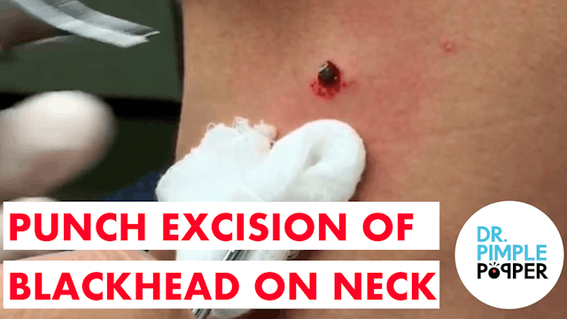 Punch Excision of a Blackhead on the Neck