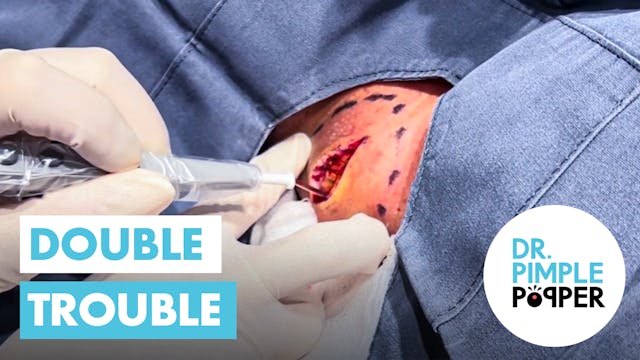 Dr Pimple Discovers "Double Trouble"