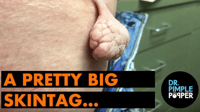 Dr Pimple Popper: A pretty big skin tag...
