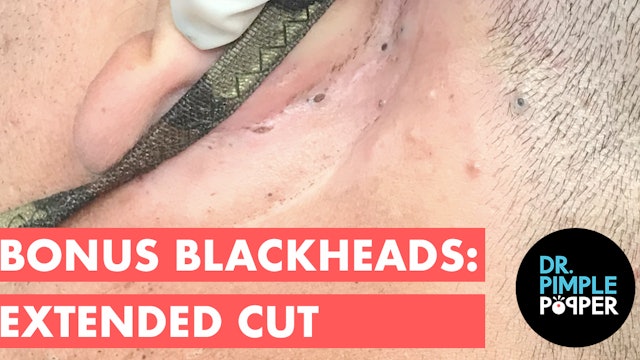 Bonus Blackheads: Extended Cut
