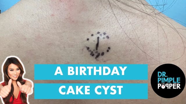 A Happy Birthday Cyst