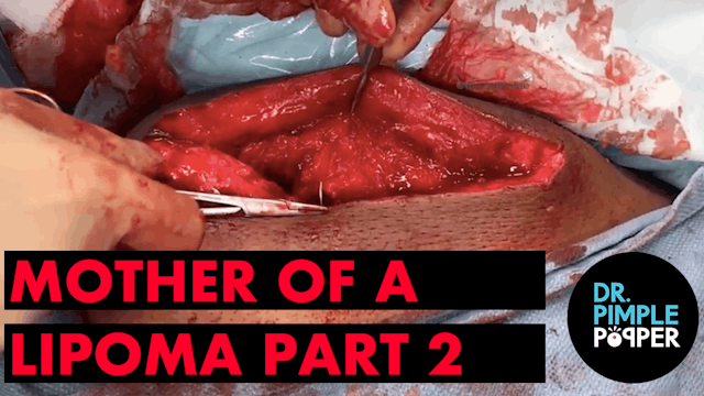 A Mother of a Lipoma Part 2