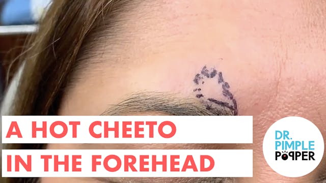 A Hot Cheeto In The Forehead