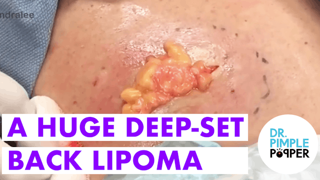 Dr. Pimple Popper Excises a Huge Deep Seated Back Lipoma