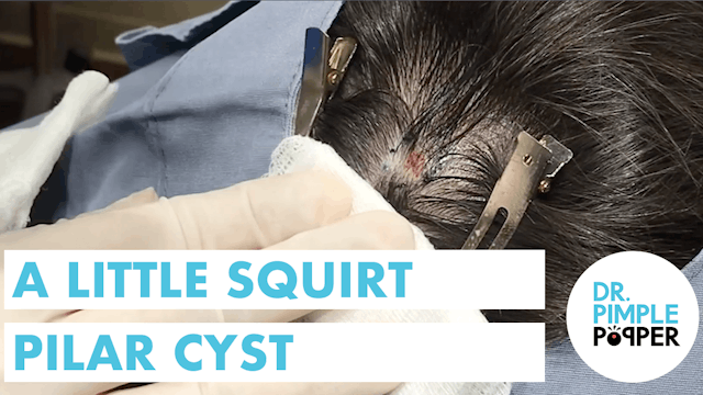 A Little Squirt Pilar Cyst