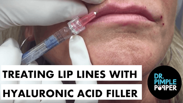 Treating Lip Lines and Downturned Lips with Hyalouronic Acid Filler