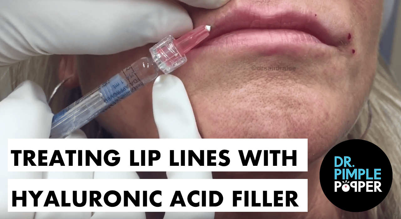 Treating Lip Lines and Downturned Lips with Hyalouronic Acid Filler A