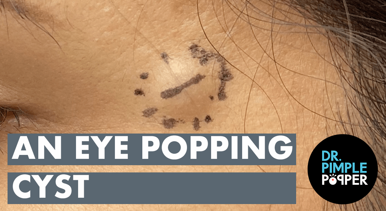 An Eye Popping Cyst Dr. Pimple Popper