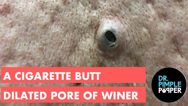A Cigarette Butt Dilated Pore of Winer