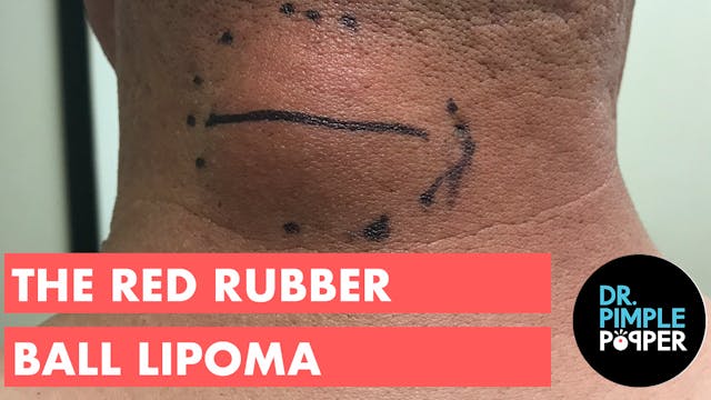 The Red Rubber Ball Lipoma