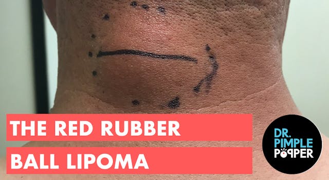 The Red Rubber Ball Lipoma