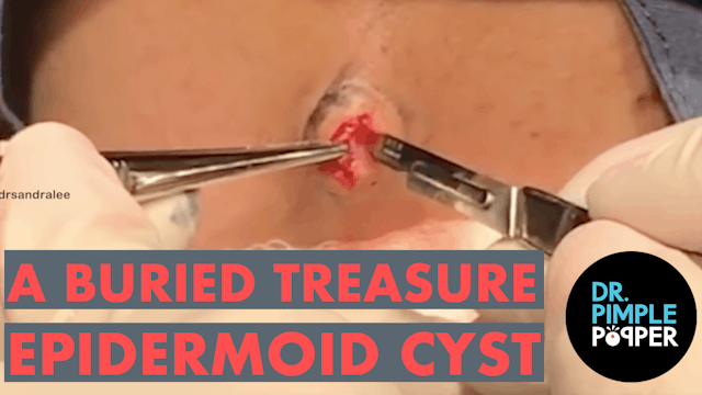The Buried Treasure Epidermoid Cyst