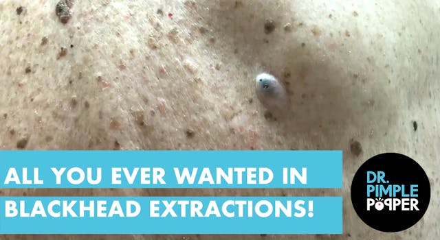 All you ever wanted in Blackhead Extr...
