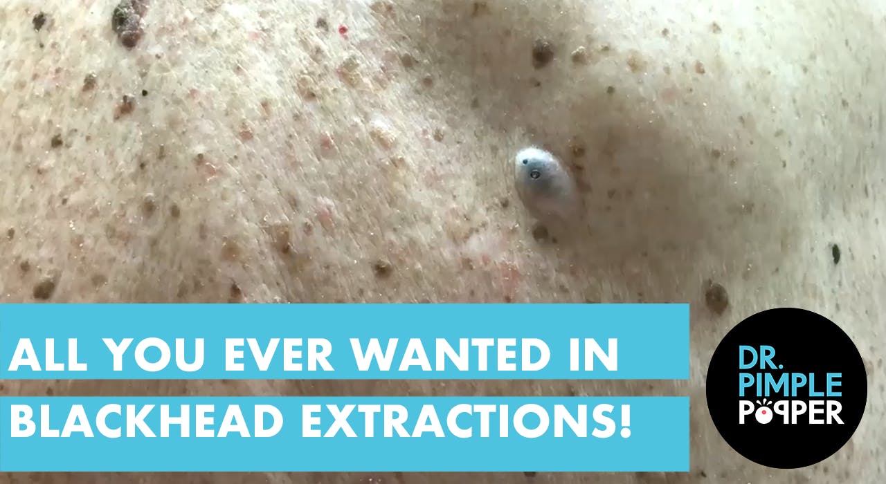 All you ever wanted in Blackhead Extractions Dr. Pimple Popper