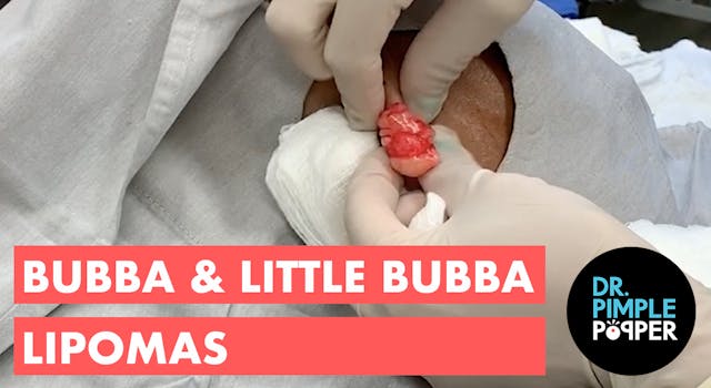 Bubba & Little Bubba Lipoma