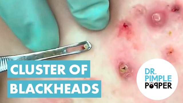 50 Minutes of Blackheads